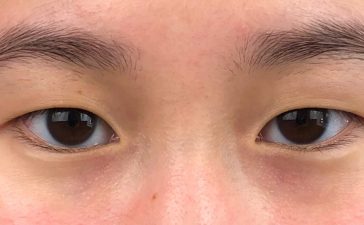 Double Eyelid Surgery Unveiling Beauty Through Precision and Artistry