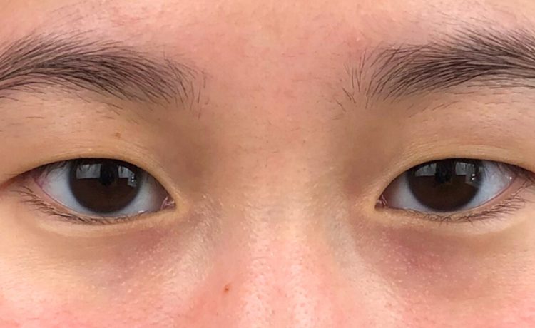 Double Eyelid Surgery Unveiling Beauty Through Precision and Artistry