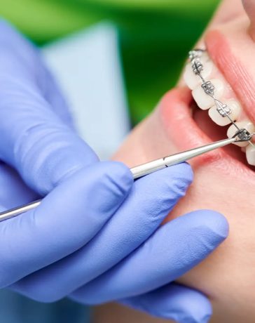 Dentists Assist with the Installation and Maintenance of Braces