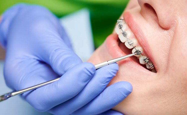 Dentists Assist with the Installation and Maintenance of Braces