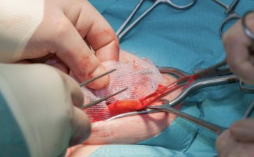 Restoring Comfort and Confidence How the Right Hernia Surgeon Can Transform Recovery