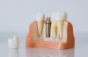 Reasons Why The Use Of Dental Implants Is Increasing With Each Passing Day