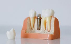 Reasons Why The Use Of Dental Implants Is Increasing With Each Passing Day