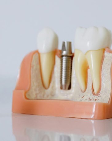 Reasons Why The Use Of Dental Implants Is Increasing With Each Passing Day