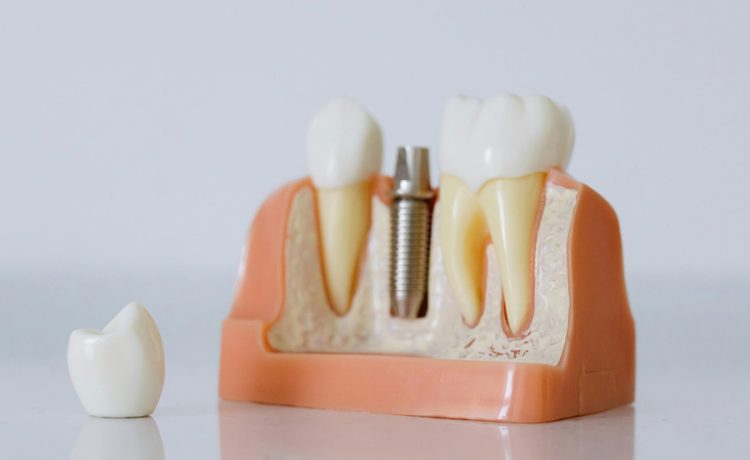 Reasons Why The Use Of Dental Implants Is Increasing With Each Passing Day